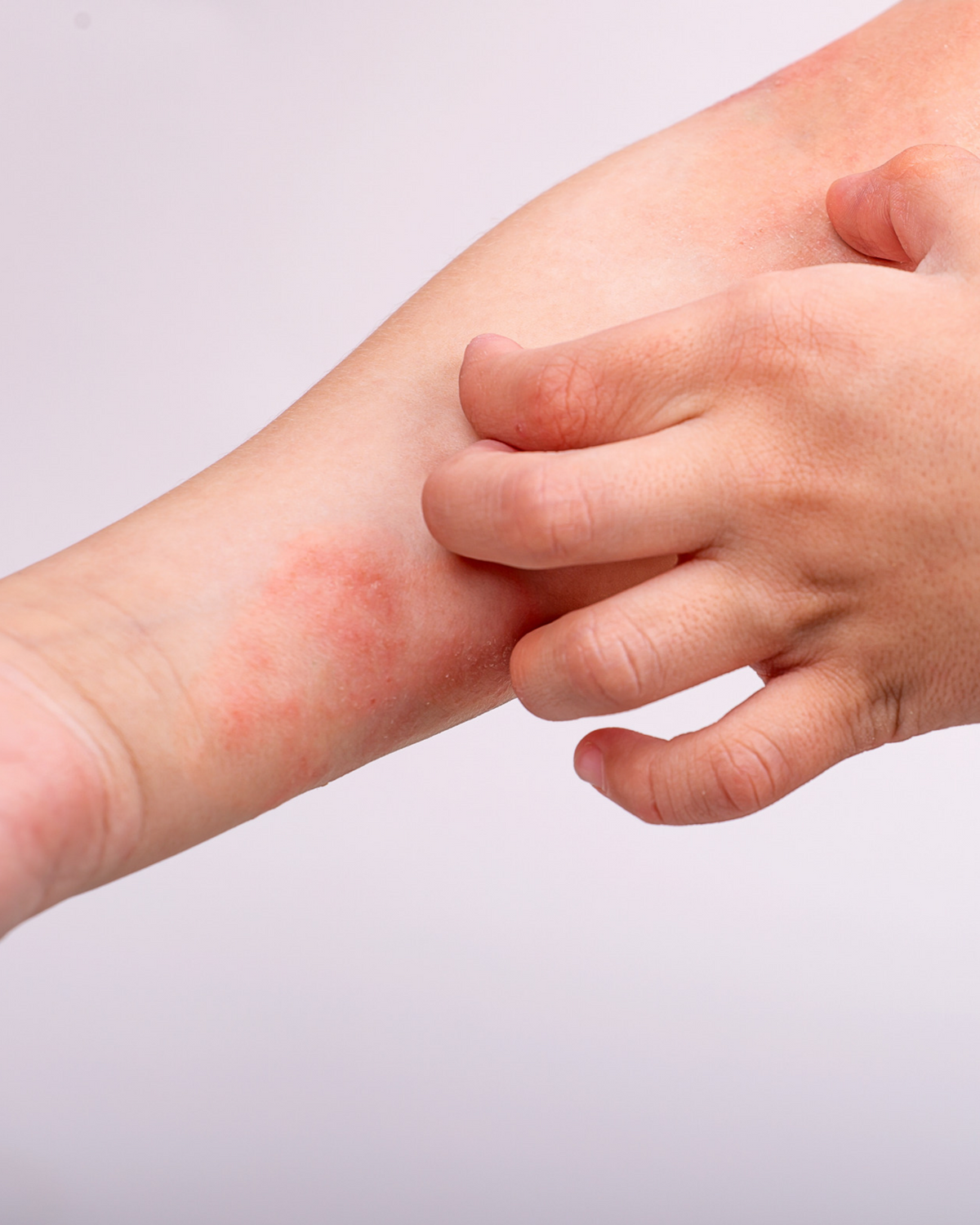 Atopijski dermatitis: zašto se javlja, simptomi i njega kože